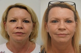 أفضل جراحة تجديد البشرة بالبلازما في الرياض