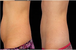 أفضل جراحة تجميد الدهون بتقنية كول سكلبتينج في الرياض