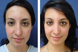 أفضل جراحة تجميل الأنف المغلق في الرياض