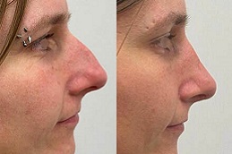 أفضل جراحة تجميل الأنف في الرياض