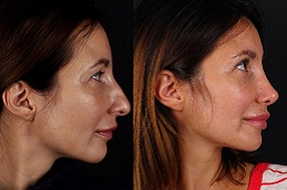 أفضل جراحة تجميل الأنف في الرياض