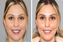 أفضل جراحة تجميل الغمازات في الرياض