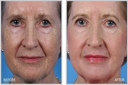 أفضل جراحة تجميل الوجه في الرياض