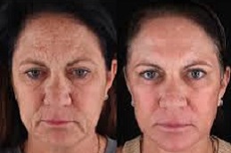 أفضل جراحة تحليل البشرة بتقنية VISIA في الرياض