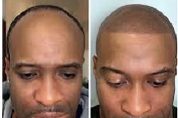 أفضل جراحة تصبغ فروة الرأس الدقيق في الرياض