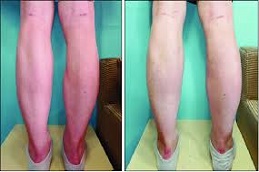 أفضل جراحة تصغير الساق في الرياض