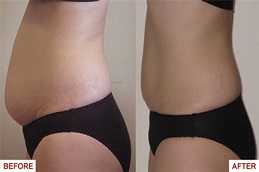 أفضل جراحة تفتيت الدهون بالليزر في الرياض