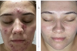 أفضل جراحة تقشير البشرة بالتوهج في الرياض