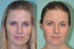 أفضل جراحة تقشير الجلد بالإبر الدقيقة بتقنية الترددات الراديوية الجزئية في الرياض