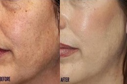 أفضل جراحة تقشير الماندليك في الرياض