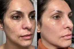 أفضل جراحة تقشير اليقطين العضوي في الرياض