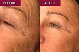 أفضل جراحة تقشير حمض الجليكوليك في الرياض