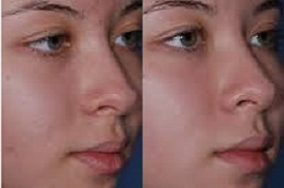 أفضل جراحة تقشير حمض الساليسيليك في الرياض