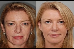 أفضل جراحة تقشير ماسي في الرياض