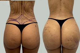 أفضل جراحة تكبير الأرداف في الرياض