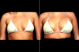 أفضل جراحة تكبير الثدي بتقنية AFT في الرياض