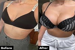 أفضل جراحة تكبير الثدي بدون ندوب في الرياض