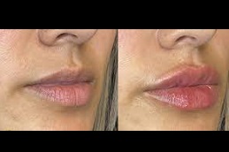 أفضل جراحة تكبير الشفاه في الرياض