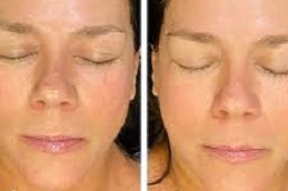 أفضل جراحة تنظيف عميق للوجه في الرياض