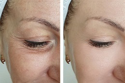 أفضل جراحة تنعيم التجاعيد في الرياض