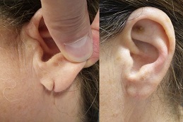 أفضل جراحة ثقب الأذن في الرياض