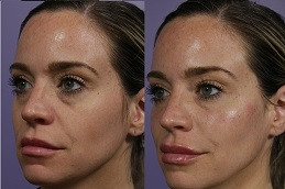 أفضل جراحة حشو الخدود في الرياض