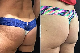 أفضل جراحة حشو المؤخرة في الرياض