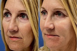 أفضل جراحة حشوات بيلوتيرو في الرياض