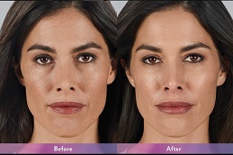 أفضل جراحة حشوات جوفيديرم في الرياض