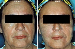 أفضل جراحة حشوات راديس في الرياض