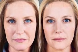 أفضل جراحة حشوات سكلبترا في الرياض