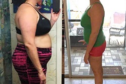 أفضل جراحة حصوات المرارة في الرياض