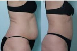 أفضل جراحة حقن أكواليكس في الرياض