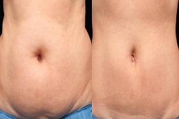 أفضل جراحة حقن إذابة الدهون في الرياض