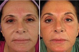 أفضل جراحة حقن البلازما الغنية بالصفائح الدموية في الرياض