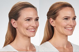 أفضل جراحة حقن البوتوكس للتجاعيد في الرياض