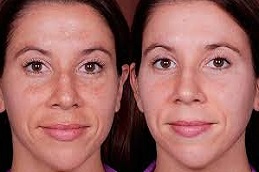 أفضل جراحة حقن الجلوتاثيون في الرياض