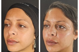 أفضل جراحة حقن حمض الهيالورونيك في الرياض