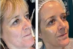 أفضل جراحة حقن سونيكوس في الرياض