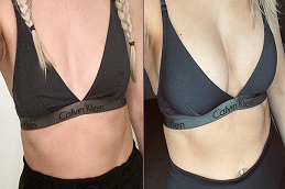 أفضل جراحة حقن فيلر الثدي في الرياض