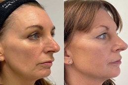 أفضل جراحة خيوط أبتوس في الرياض