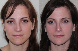 أفضل جراحة رأب الحاجز الأنفي وتقليص المحارة الأنفية في الرياض