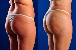 أفضل جراحة رفع المؤخرة البرازيلية في الرياض