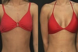 أفضل جراحة زراعة الثدي بالسيليكون في الرياض