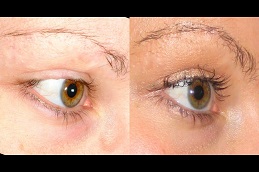 أفضل جراحة زراعة الرموش في الرياض