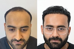 أفضل جراحة زراعة الشعر الهجين في الرياض