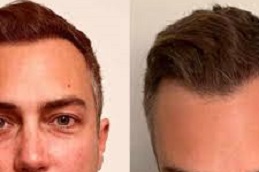 أفضل جراحة زراعة الشعر بالروبوت في الرياض