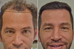 أفضل جراحة زراعة الشعر بتقنية الاقتطاف (FUE) في الرياض