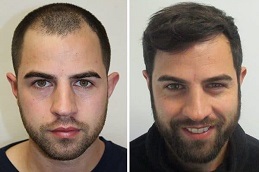 أفضل جراحة زراعة الشعر في الرياض