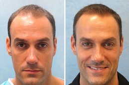 أفضل جراحة زراعة الشعر للرجال في الرياض